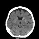 Infarction in basal ganglia, hemorrhagic transformation: CT - Computed tomography